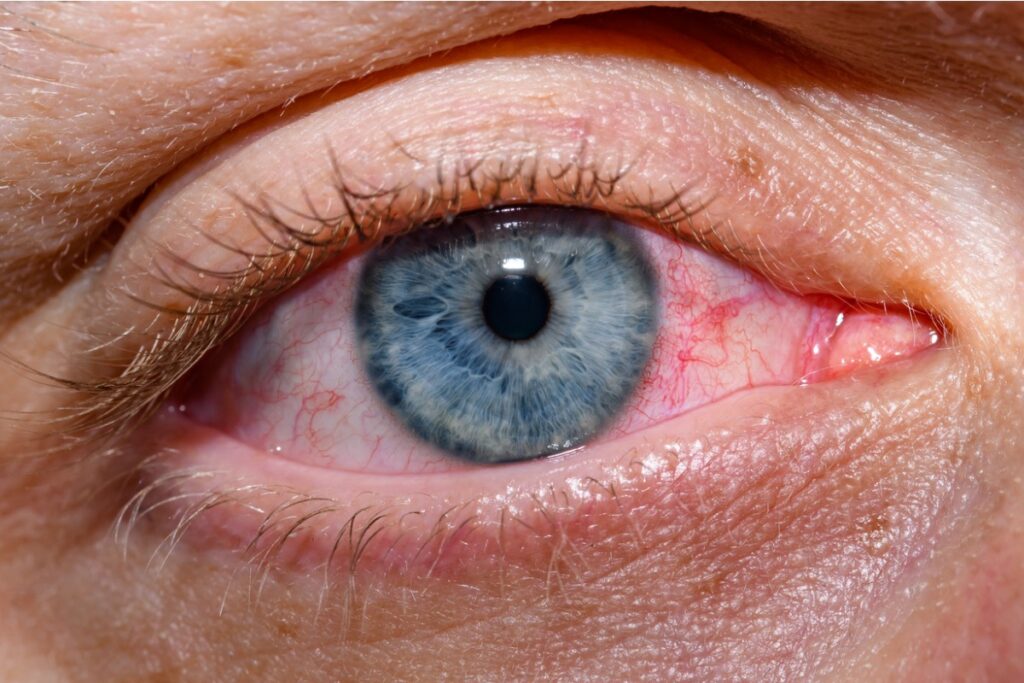 pink eye care | Andover & Winfield Family Optometry