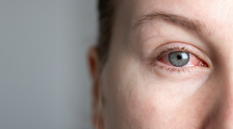 dry red eyes | Andover & Winfield Family Optometry